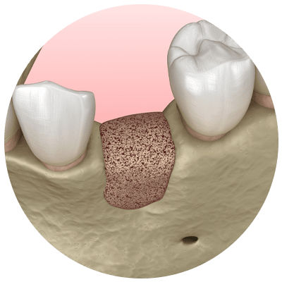 bone grafting