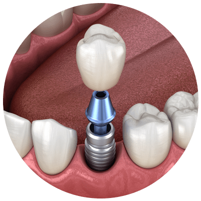 dental implant model