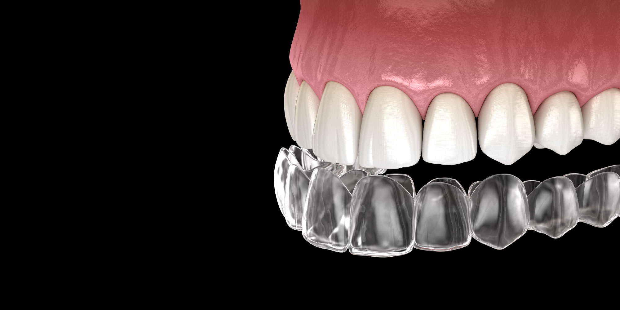 invisalign graphic